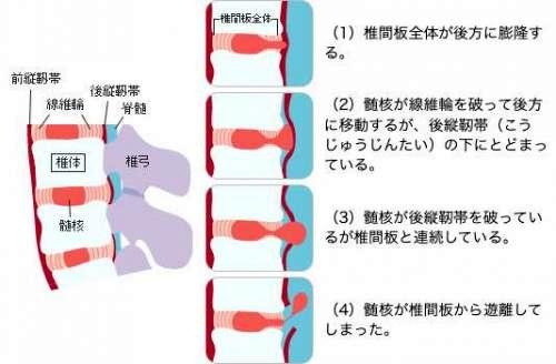 ヘルニア　図解.jpg