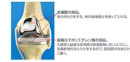 人口関節.jpg